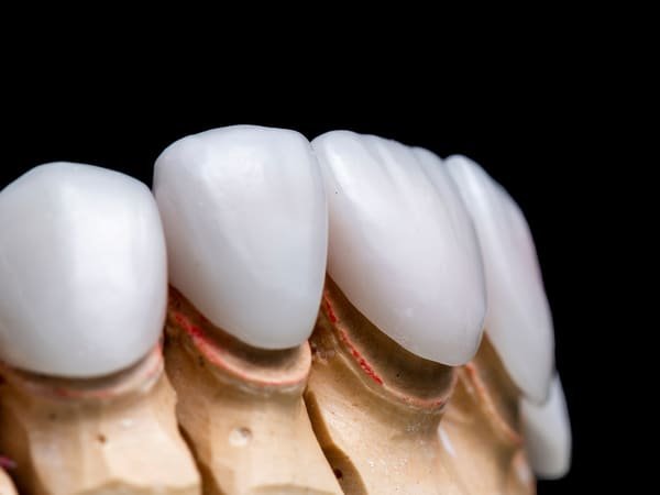 ZIRCONIA
